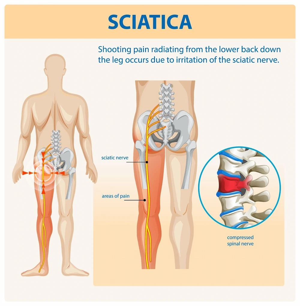 Understanding sciatica and its symptoms